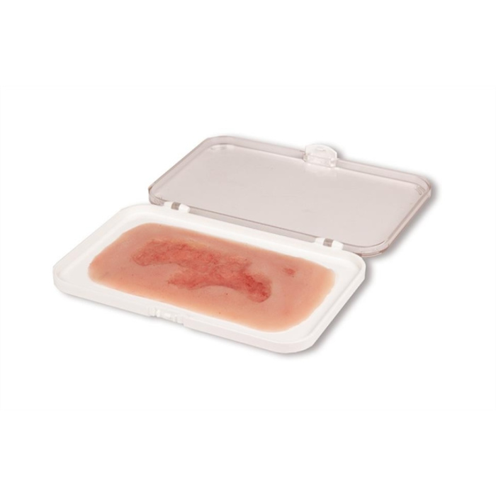 Moulage de plaie ulcère de jambe veineux, petit, phase d'épithélisation Moulage de plaie ulcère de jambe veineux, petit, phase d'épithélisation