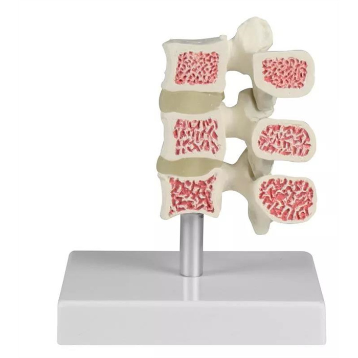 Osteoporosis vertebrae model, 3 vertebrae Osteoporosis vertebrae model, 3 vertebrae