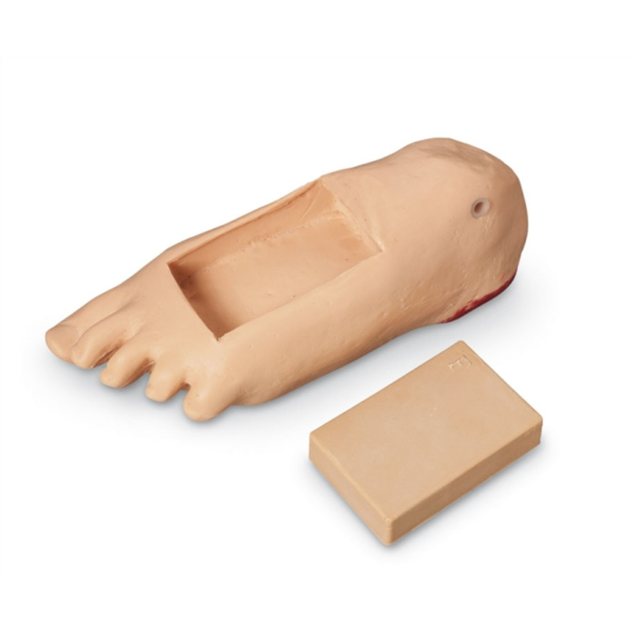 Pied à œdème avec nécrose profonde des tissus Pied à œdème avec nécrose profonde des tissus