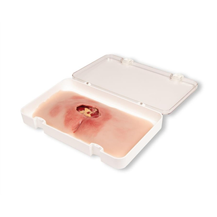 Wound moulage sacral decubitus, cleaned Wound moulage sacral decubitus, cleaned