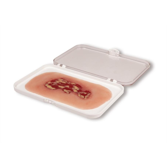 Wound moulage venous leg ulcer, small, exudation phase Wound moulage venous leg ulcer, small, exudation phase